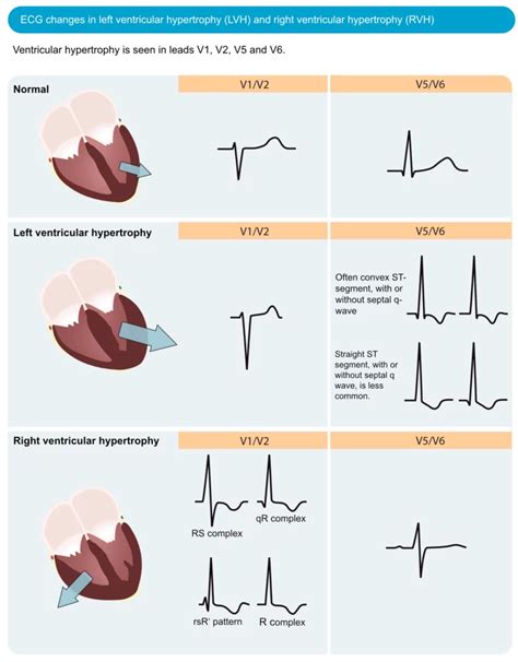 left ventricular overload on ekg.